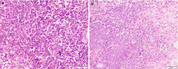 2 microscopic images of round and oval cells with hyperchromatic nucleoli in the stroma.