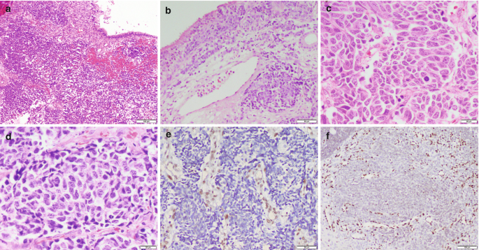 6 microscopic images with cellular and intercellular structures. The cells are oval, round, and fusiform and the nucleoli are prominent and hyperchromatic.