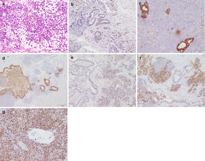 7 microscopic images with dark and light staining for cellular and intercellular spaces. A has rosette patterned cells. B and c have lobules formed of round cells. D, e, and f have cells forming branch-like structures. G has a vacuole surrounded by round cells.