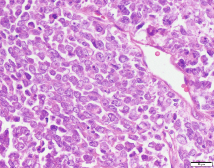 A microscopic image of rhabdoid variant cancerous cells. On the right is a spindle-shaped vacuole.