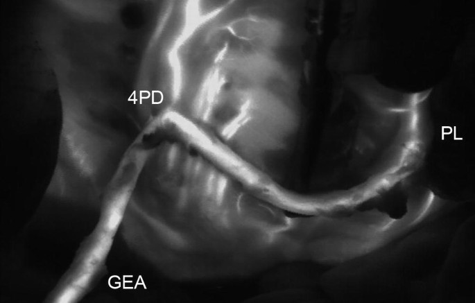 A screenshot of the heart that depicts the enlarged visuals of the artery during coronary angiography. The terms displayed from the top left in a clockwise direction are 4 P D, P L , and G E A.