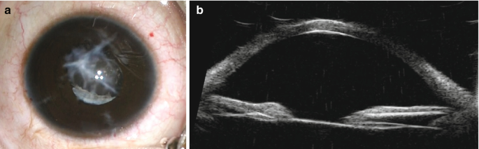 A close-up view and a scanned image of an eye labeled a and b. a, the photo highlights a zoomed-in view of the pupil with a light-shaded region. b, the scan presents the anterior view of the eyeball.