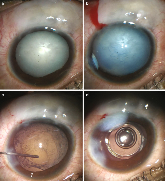 Four close-up views of an eye labeled a to d. a displays the cataract, b displays bleeding above the eyeball, and c, an arrow in the lower part of the eye indicates the displacement of the lens. d presents the fixation of the capsular ring around the artificial lens.