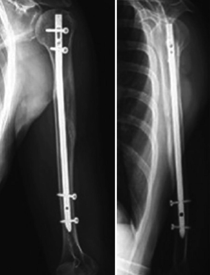 PDF] Antegrade Interlocking Intramedullary Nailing in Humeral Shaft  Fractures | Semantic Scholar