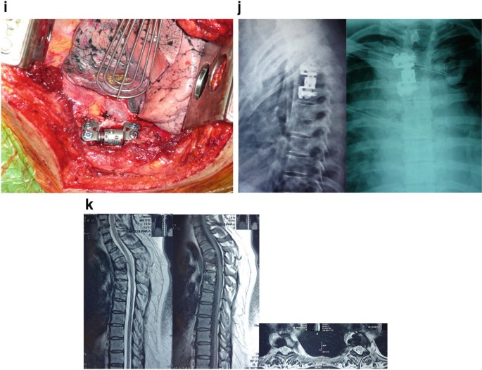 K Eckland – Thoracic Surgery