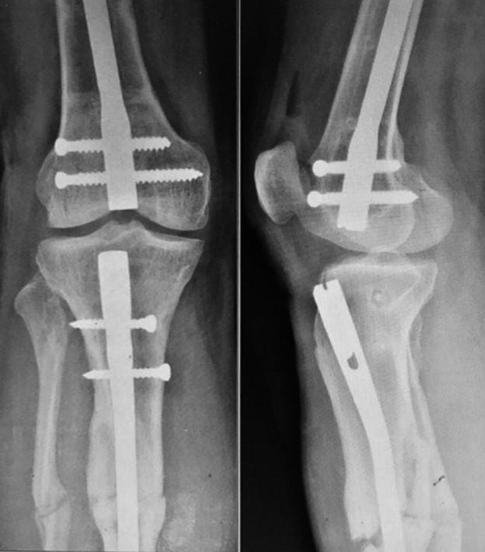 The geriatric distal femur fracture: nail, plate or both? | European  Journal of Orthopaedic Surgery & Traumatology