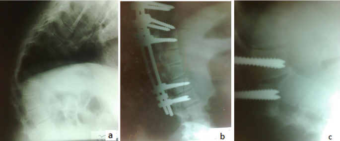 X ray dorso lumbar spine A/P and lateral views showing Kypho