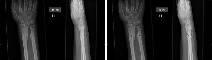 Defining the Clinical and Radiological Endpoint of a Successfully Fixed ...