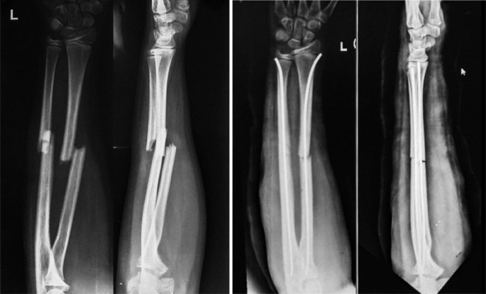 Interlocked nailing for treatment of segmental fractures of the femur. |  Semantic Scholar