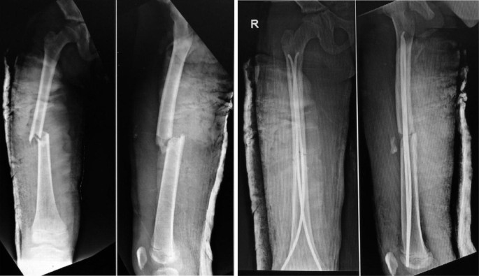 Reduction and stabilization of radial neck fractures by intramedullary  pinning: a technique not only for children | European Journal of Medical  Research | Full Text
