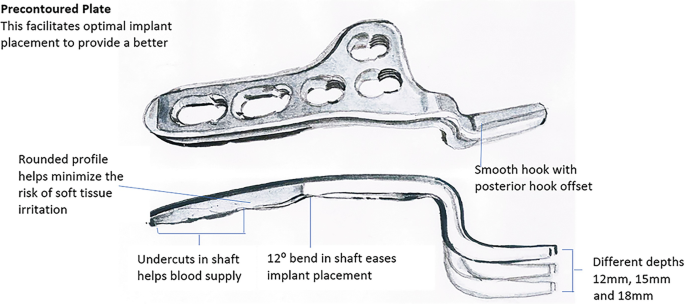 Implantology of Fractures of the Clavicle