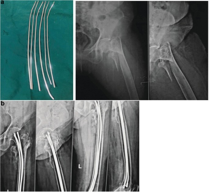 Femoral intramedullary nail - G-6303 - Suzhou Kangli Orthopaedics  Instrument - trochanter / proximal / titanium