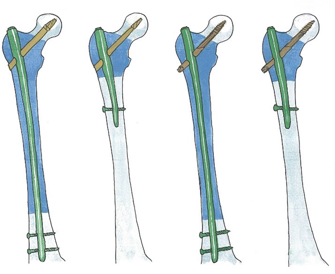 Functional outcome of patients of tibial fracture treated with solid nail  (SIGN nail) versus conventional hollow nail - A random