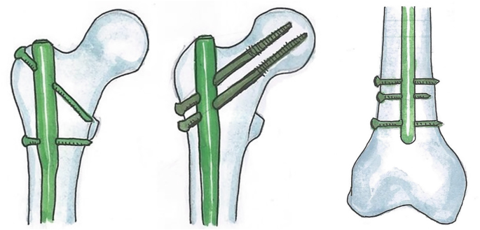 Fracture Tibia Treated With CRIF With IMIL Nail..Dr Sai Chandra  #tibiafracture #telugu - YouTube