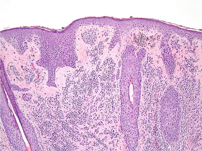 Vulvar Melanocytic Lesions | Springer Nature Link