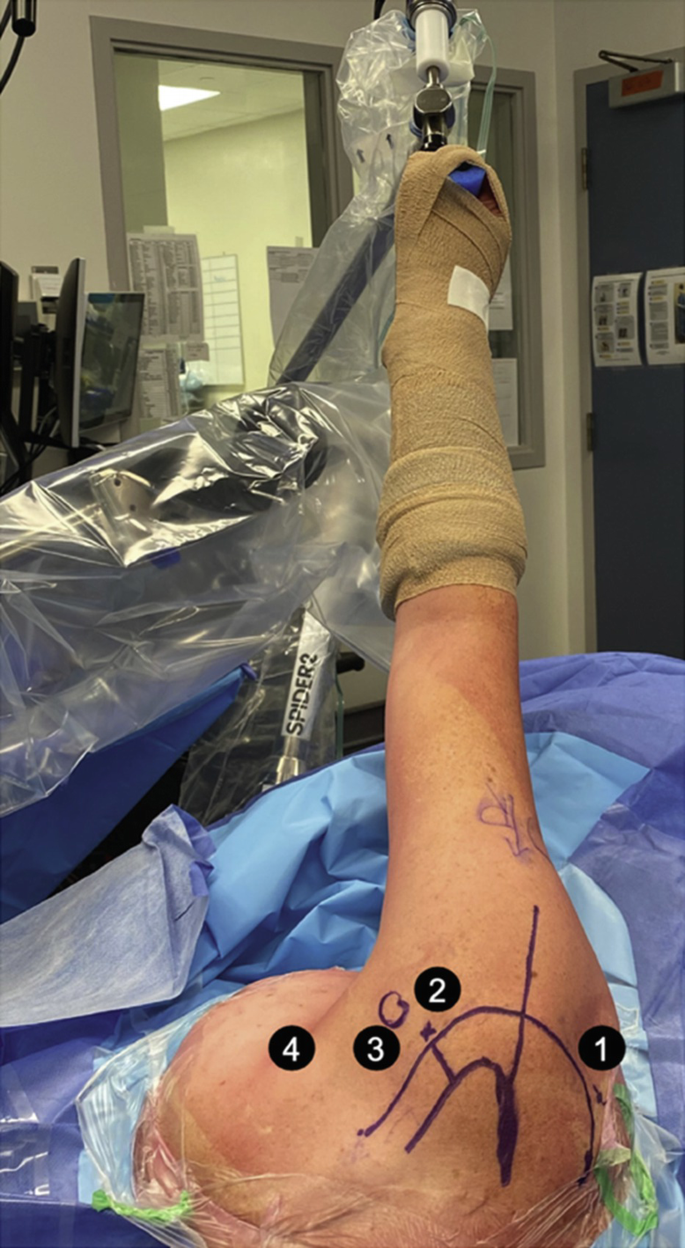 Arthroscopic Revision for Failed Latarjet Procedure | SpringerLink, image size:685x1248