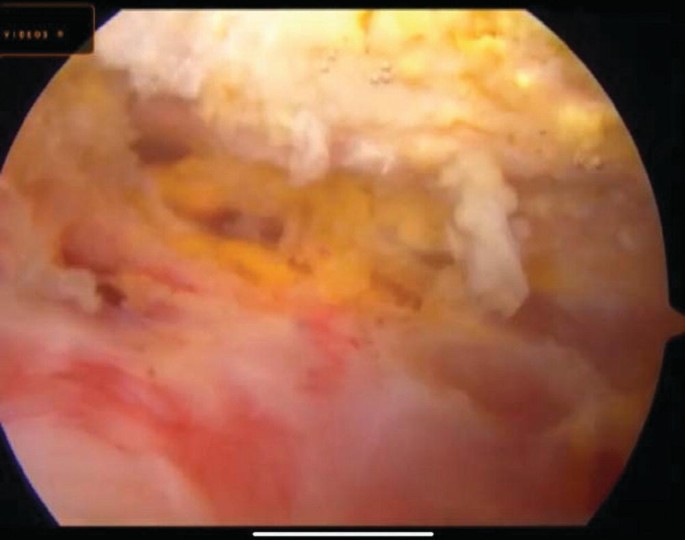 A posterior portal image of the subacromial space after bursectomy. A significant bone spur on the inferior acromion is observed.