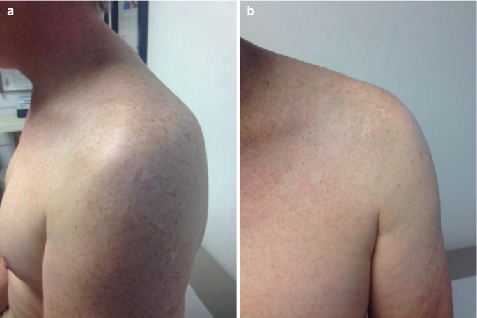 Two photos. The posterior and lateral view of a man's left shoulder in a and b.