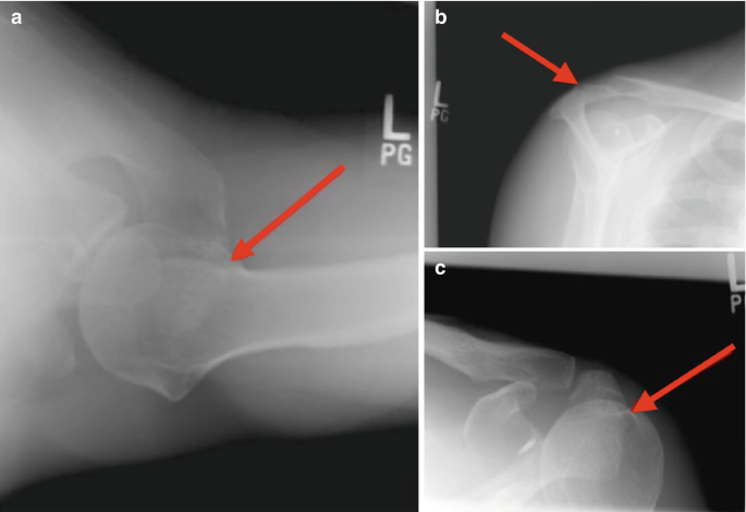 Three radiographs of the supraspinatus and glenohumeral joint.