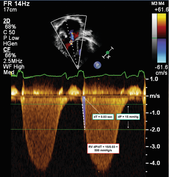 The Echocardiographic Assessment of Right Ventricular Function and ...