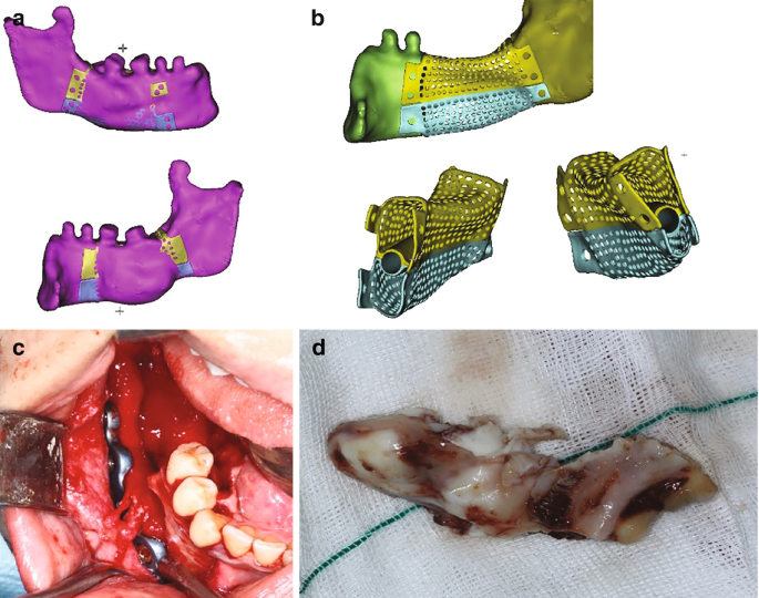 In Situ Bone Regeneration in Oral and Maxillofacial Surgery: Definition,  Indications, and Manufacturing Considerations | SpringerLink