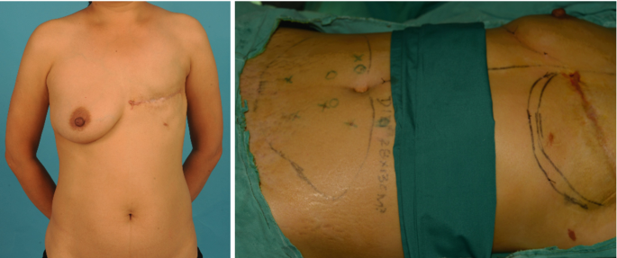 Appearance of PSPG 18 days following bilateral DIEP flap breast