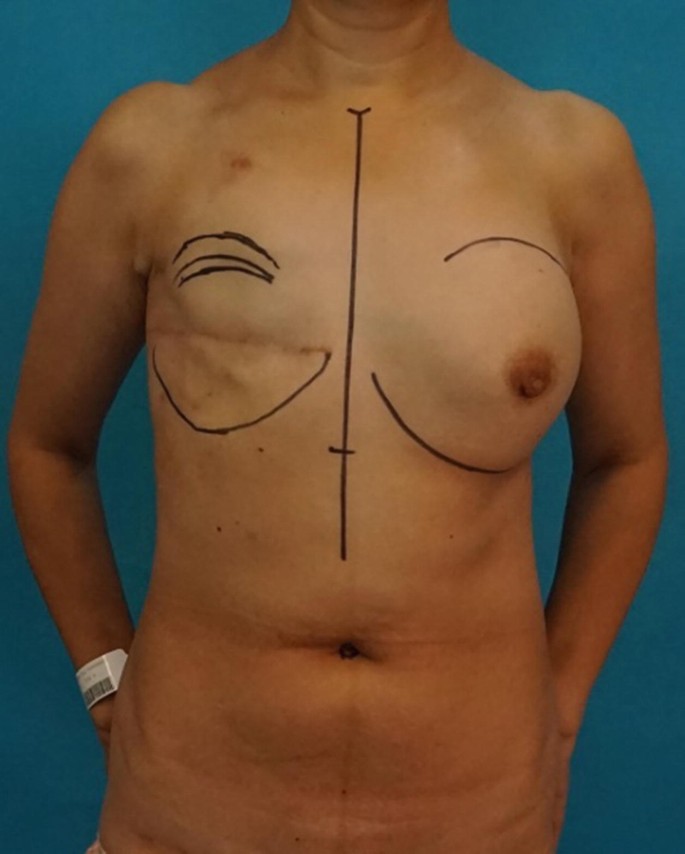 A photograph. A woman's bare body from neck to lower abdomen. The right breast is marked and the left breast after mastectomy is marked. A line is drawn between the breasts.