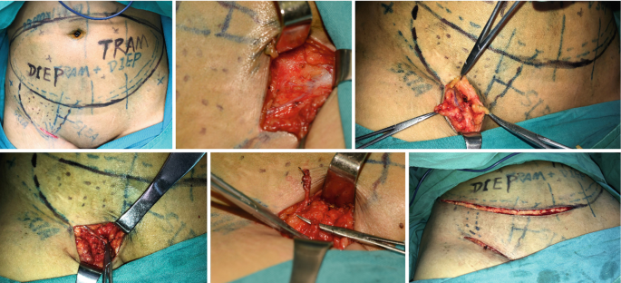 Free DIEP Flap with Ilioinguinal Lymphoid Tissue for Breast Reconstruction  and Treatment of Upper Limb Lymphedema