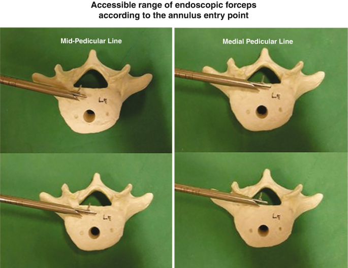 4 photographs of the L 5 spine region model, with the endoscopic forceps, indicate its working range. 2 photographs on the left describe the working range where the annulus entry point is the mid peculiar line and 2 photographs on the right indicate the working range if the annulus entry point is the medial pedicular line. Appropriate entry points must be chosen for accurate targeting of the endoscopic forceps.