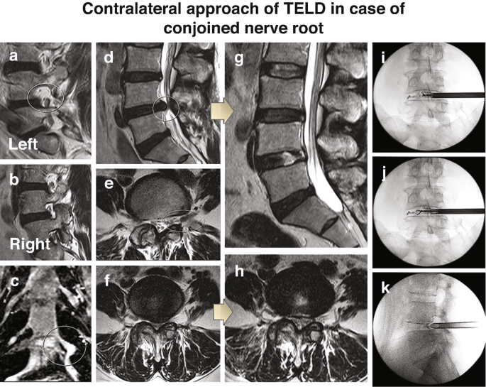 11 radiological images define the approach of T E L D used to treat conjoined nerve root. Images A to H. Preoperative M R Is of a female patient indicate intracanal disc herniation, left conjoined nerve root at L 4 5 level, and normal nerve travel on the right side. G and H. Postoperative M R Is exhibit complete removal of the herniated disc and decompression. I, J, and K are intra-operative x-ray images exhibit the contralateral approach of the T E L D procedure.