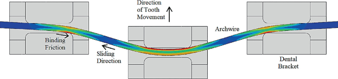 Three rectangular illustrations have a flow of sliding friction at the center. The components labeled on three structures are binding friction, sliding friction, the direction of tooth movement, arch wire, and dental bracket.