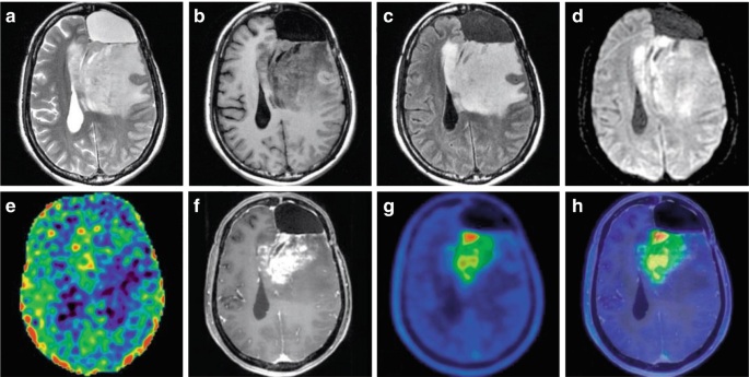 A set of 8 M R I of the axial views of the brain highlights a mass in the left frontoparietal lobe.