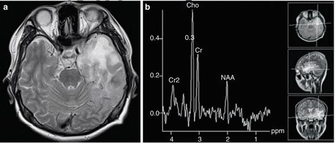 Two illustrations. A. M R I of the axial view of the brain focuses on the circular mass in the left temporal lobe. B. A fluctuating line graph marks the peaks as C r 2, C h o, C r, and N A A.