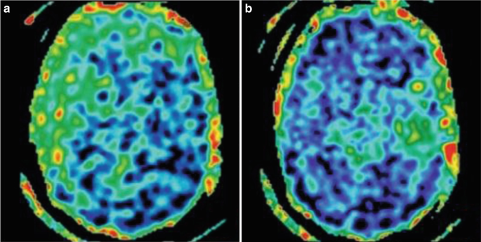 2 M R I of the axial views of the brain with stenosis of the right internal carotid artery.