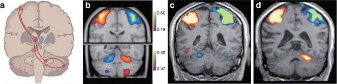 4 representations of the brain depict cerebellar activities. A is the rating state of the cerebrum and cerebellum. B depicts the connection between the cerebrum and cerebellum. C and D are images of the brain with left and right pontine infarction, respectively.