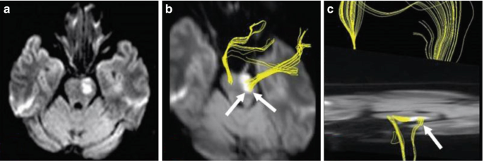 3 M R I scan of the axial views of the brain focuses on the left pontine infarction with the corticospinal tract.