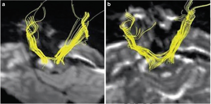 2 M R I scan of the brain highlights the right pontine infarction with the corticospinal tract.