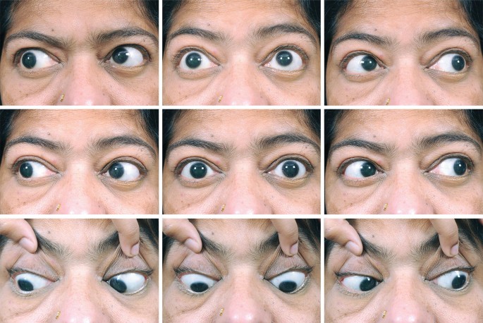 9-gaze photographs of the patient. (a) 9-gaze preoperative photographs