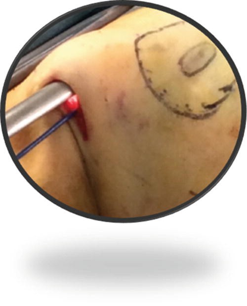 History of the Mini-Invasive Video Assisted Breast Surgery: From