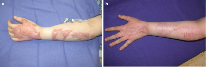 Multiple, 1‐2 cm, ulcerations and hyperpigmented, depressed scars