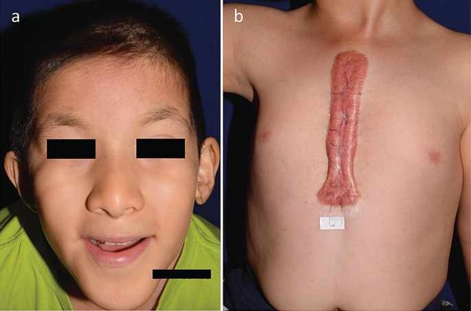 Keloids in Rubinstein–Taybi syndrome: a clinical study - Kar