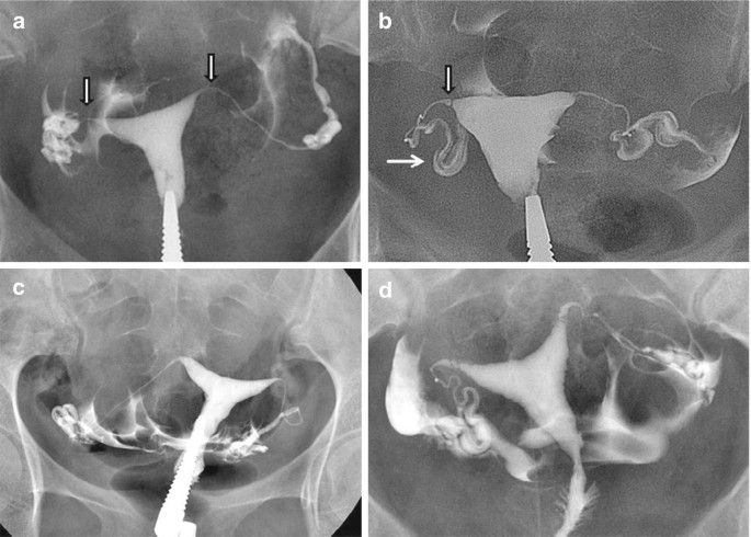 Role of Hysterosalpingography (HSG) and Sono-HSG | SpringerLink