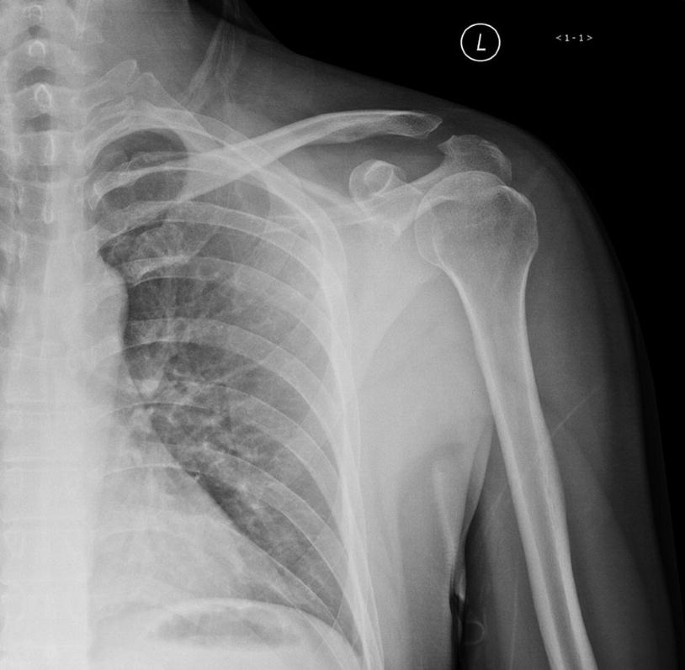 Ewing Sarcoma: Case 18 | SpringerLink