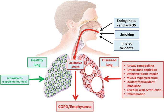 Targeting Molecular and Cellular Mechanisms in Chronic Obstructive Pulmonary Disease | Springer Nature Link Targeting Molecular and Cellular Mechanisms in Chronic Obstructive Pulmonary Disease | Springer Nature Link