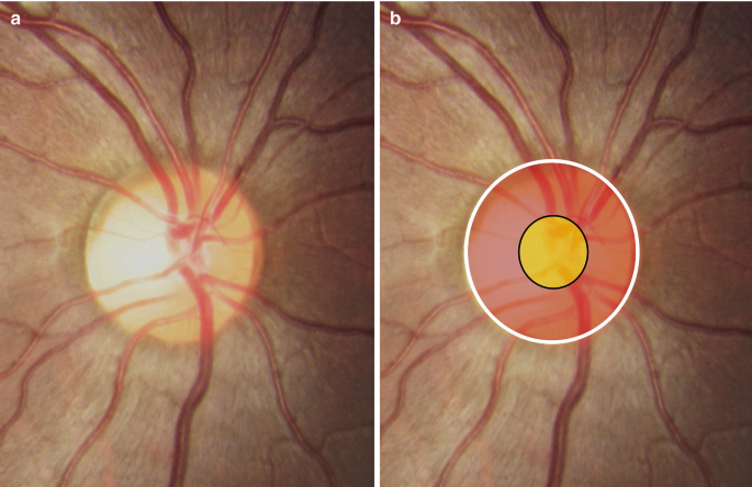 What Is the Range of Normal Variations in the Optic Nerve Head Appearance?  | SpringerLink