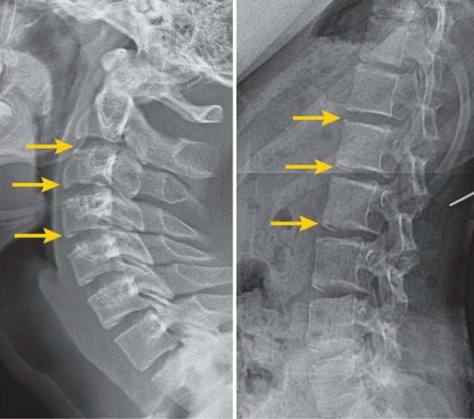 Spine Development Radiology Development of Normal Pediatric Spine and Congenital Spinal and Spinal ...