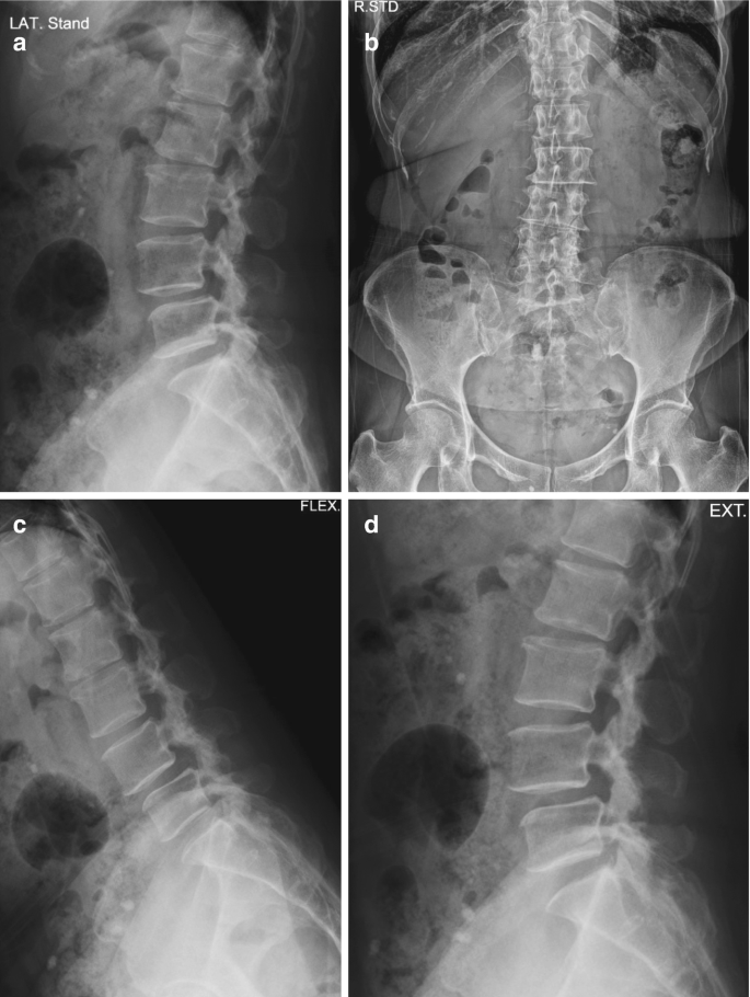 Radiologic Evaluation of Lumbar Spinal Stenosis | Springer Nature Link