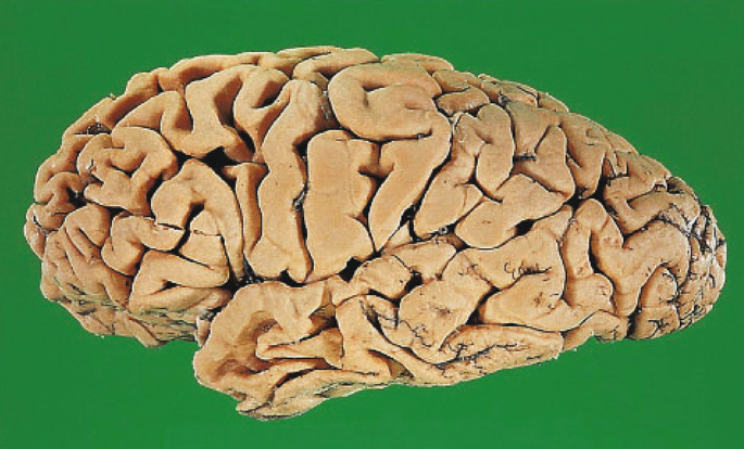 Extra Lumpy Brain Neuropathological Diagnoses of Dementia | Springer Nature Link