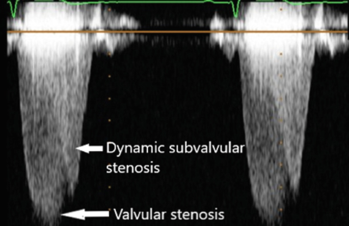 Subvalvular Ring Right Ventricular Outflow Anomalies | SpringerLink