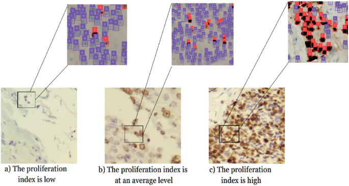 Detection and Evaluation of Ki-67 Proliferation Index of Breast Cancer ...
